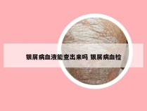 银屑病血液能查出来吗 银屑病血检