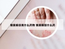 银屑癣该用什么药物 银屑癣搽什么药