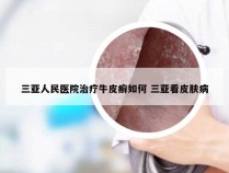 三亚人民医院治疗牛皮癣如何 三亚看皮肤病