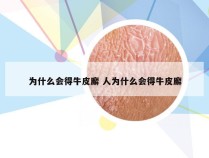 为什么会得牛皮廨 人为什么会得牛皮廨