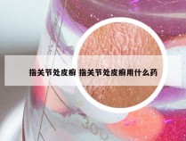 指关节处皮癣 指关节处皮癣用什么药