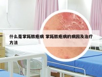 什么是掌跖脓疱病 掌跖脓疱病的病因及治疗方法