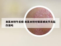 来氟米特牛皮癣 来氟米特对银屑病关节炎起作用吗