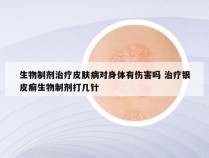 生物制剂治疗皮肤病对身体有伤害吗 治疗银皮癣生物制剂打几针