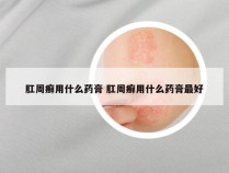 肛周癣用什么药膏 肛周癣用什么药膏最好