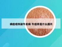 病痘疮样副牛皮癣 牛痘疹是什么图片