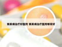 银屑病治疗好医院 银屑病治疗医院哪家好