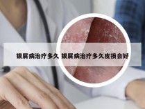 银屑病治疗多久 银屑病治疗多久皮损会好