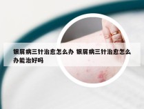 银屑病三针治愈怎么办 银屑病三针治愈怎么办能治好吗