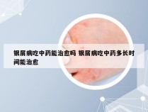 银屑病吃中药能治愈吗 银屑病吃中药多长时间能治愈