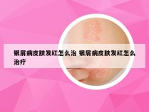 银屑病皮肤发红怎么治 银屑病皮肤发红怎么治疗