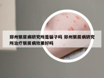 郑州银屑病研究所是骗子吗 郑州银屑病研究所治疗银屑病效果好吗