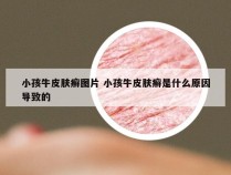 小孩牛皮肤癣图片 小孩牛皮肤癣是什么原因导致的