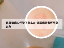 银屑病病人怀孕了怎么办 银屑病患者怀孕怎么办