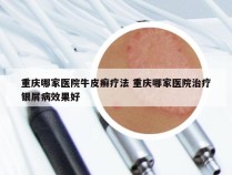 重庆哪家医院牛皮癣疗法 重庆哪家医院治疗银屑病效果好