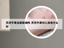 天然牛黄治银屑病吗 天然牛黄对人体有什么好