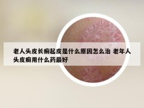 老人头皮长癣起皮是什么原因怎么治 老年人头皮癣用什么药最好