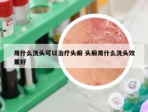 用什么洗头可以治疗头癣 头癣用什么洗头效果好