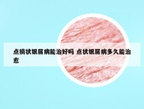 点摘状银屑病能治好吗 点状银屑病多久能治愈