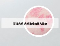 百度头癣 头癣治疗的五大措施