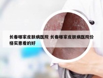 长春哪家皮肤病医院 长春哪家皮肤病医院价格实惠看的好