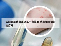 头部银屑病怎么这么不容易好 头部银屑病好治疗吗