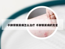 手脚得银屑病怎么治疗 手脚银屑病的克星