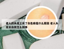 老人的头皮上长了白色癣是什么原因 老人头皮长白斑怎么回事