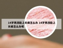 14岁男孩脸上长癣怎么办 14岁男孩脸上长癣怎么办呢