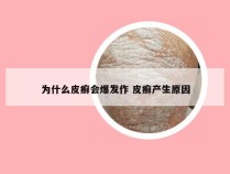 为什么皮癣会爆发作 皮癣产生原因