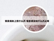 银屑病身上擦什么药 银屑病涂抹什么药止痒