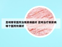 昆明那家医院治银屑病最好 昆明治疗银屑病哪个医院效果好