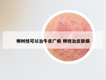 柳树枝可以治牛皮广癣 柳枝治皮肤病