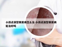 小孩点滴型银屑病怎么治 小孩点滴型银屑病能治好吗