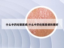 什么中药吃银屑病 什么中药吃银屑病效果好