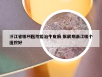 浙江省哪所医院能治牛皮癣 银屑病浙江哪个医院好