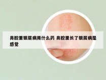 鼻腔里银屑病用什么药 鼻腔里长了银屑病是感觉