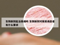 生物制剂能治银病吗 生物制剂对银屑病患者有什么要求