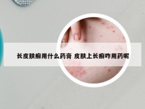 长皮肤癣用什么药膏 皮肤上长癣咋用药呢