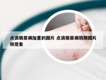 点滴银屑病加重的图片 点滴银屑病初期图片和现象