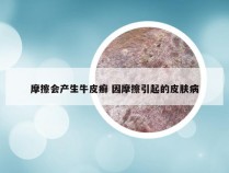 摩擦会产生牛皮癣 因摩擦引起的皮肤病