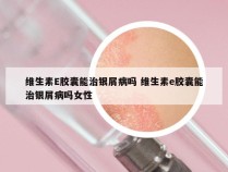 维生素E胶囊能治银屑病吗 维生素e胶囊能治银屑病吗女性