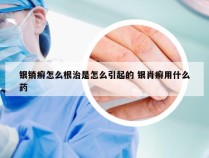 银销癣怎么根治是怎么引起的 银肖癣用什么药