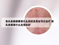 有头皮癣需要用什么样的洗发水可以治疗 有头皮癣用什么洗发水好