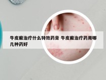 牛皮廨治疗什么特效药膏 牛皮廨治疗药用哪几种药好