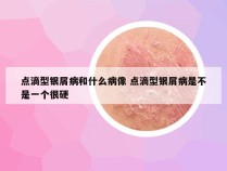 点滴型银屑病和什么病像 点滴型银屑病是不是一个很硬