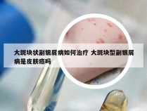 大斑块状副银屑病如何治疗 大斑块型副银屑病是皮肤癌吗