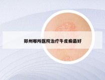 郑州哪所医院治疗牛皮癣最好