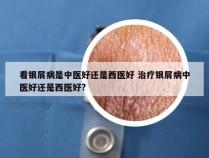 看银屑病是中医好还是西医好 治疗银屑病中医好还是西医好?