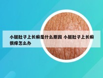 小腿肚子上长癣是什么原因 小腿肚子上长癣很痒怎么办